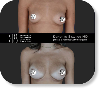 Fat transfer to breasts