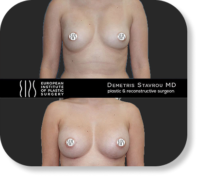 Fat transfer to breasts