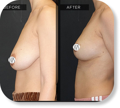 Breast Lift (Mastopexy)