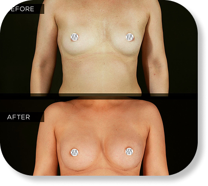 Breast reconstruction