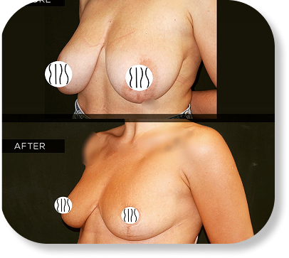 Breast Reduction