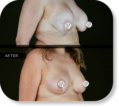 Implant Revision & replacment